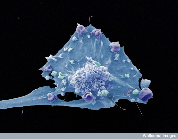 breastcancercell.jpg